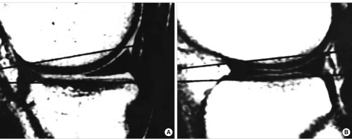 Fig. 1. (A) The measurement of angle between medial meniscal slope and medial bony slope