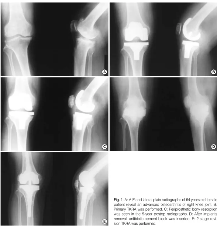 Fig. 1. A: A-P and lateral plain radiographs of 64 years old female patient reveal an advanced osteoarthritis of right knee joint