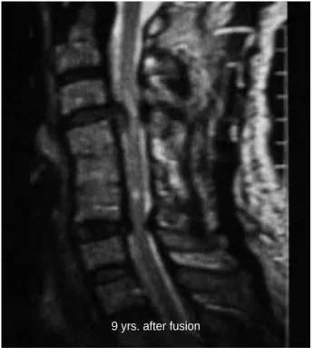 Fig. 3. Nine years after C4-5-6 interbody fusion, a huge C3-4 and C6-7 disc herniation is seen.