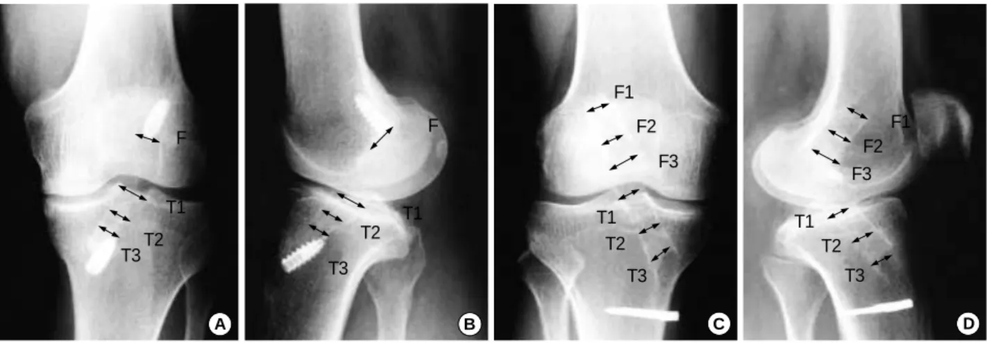Fig. 1. The measurement of the tunnel enlargement. A: AP views of the Bone-Patellar Tendon-Bone graft group, B: Lateral view of the Bone-Patellar Tendon-Bone graft group, C: AP views of the Hamstring graft group, D; B: Lateral view of the Hamstring graft g