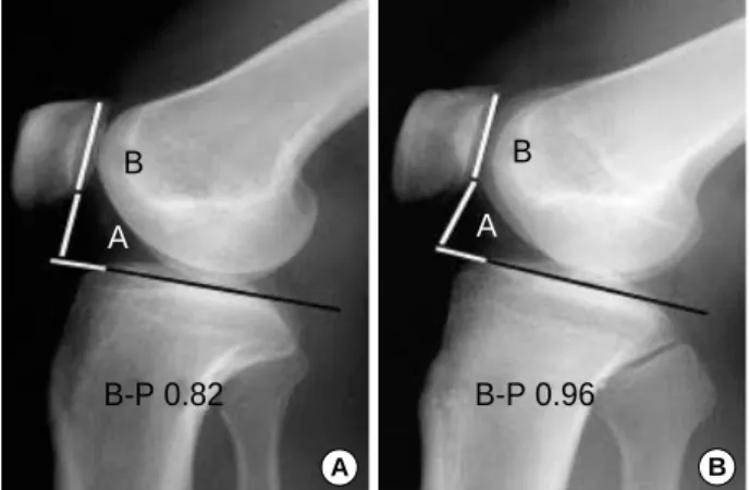 Fig. 1. (A) A radiograph of normal patellar height. The ratio of the Blackburne &amp; Peel method (B-P) is 0.82