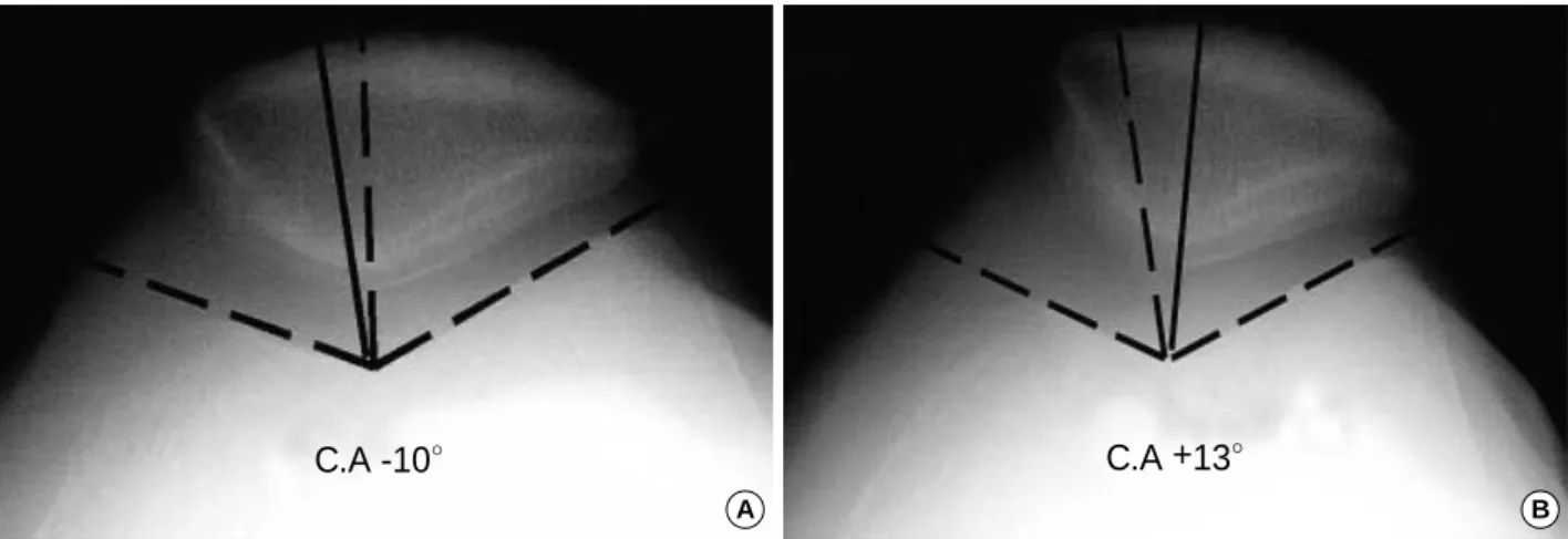 Fig. 2. (A) A radiograph of a normal congruence angle. The congruence angle of a normal knee is -10°