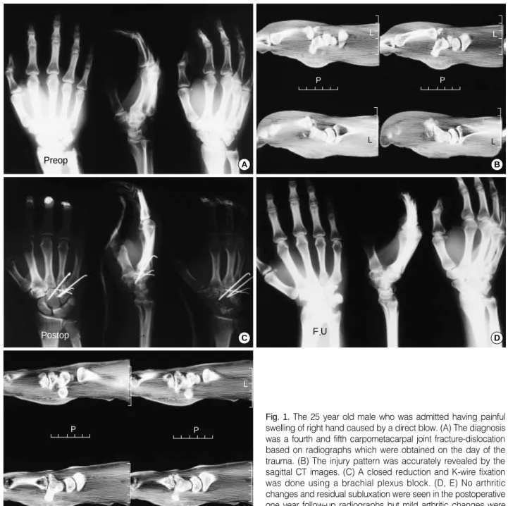 Fig. 1. The 25 year old male who was admitted having painful swelling of right hand caused by a direct blow