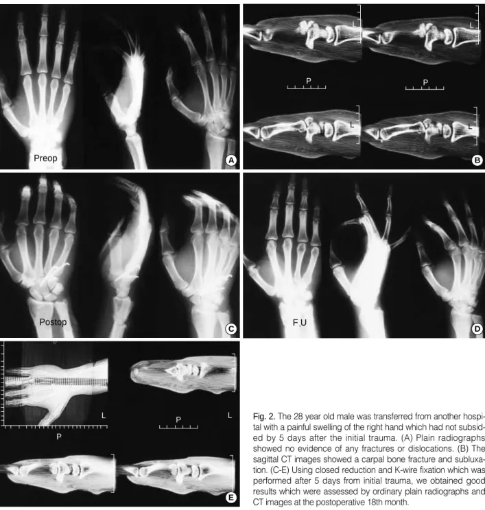 Fig. 2. The 28 year old male was transferred from another hospi- hospi-tal with a painful swelling of the right hand which had not  subsid-ed by 5 days after the initial trauma