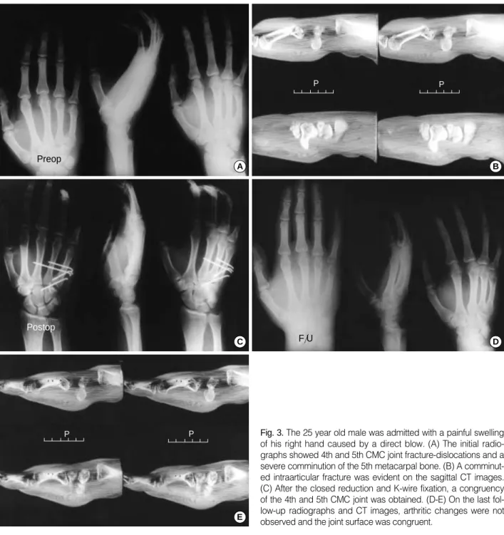 Fig. 3. The 25 year old male was admitted with a painful swelling of his right hand caused by a direct blow