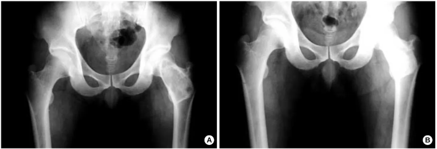 Fig. 2. A: Plain radiograph shows a huge ground-glass lesion with complete rim of sclerosis, suggesting benign, long-standing or ancient lesion, that involves the entire neck and trochanteric region