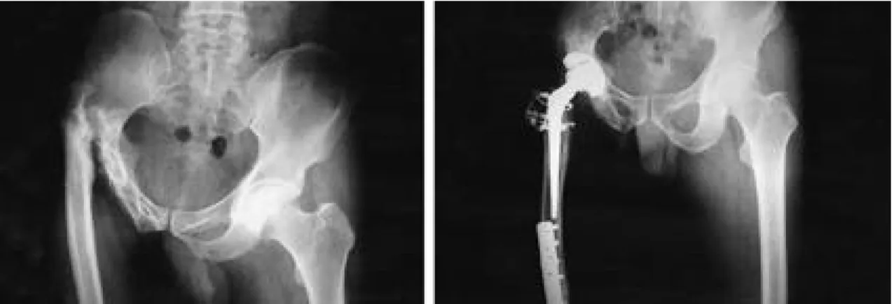 Fig. 1-A. Preoperative AP view showed severe deformed femur and marked destructive hip with proximal migration in right side as a sequale of the tuberculosis.