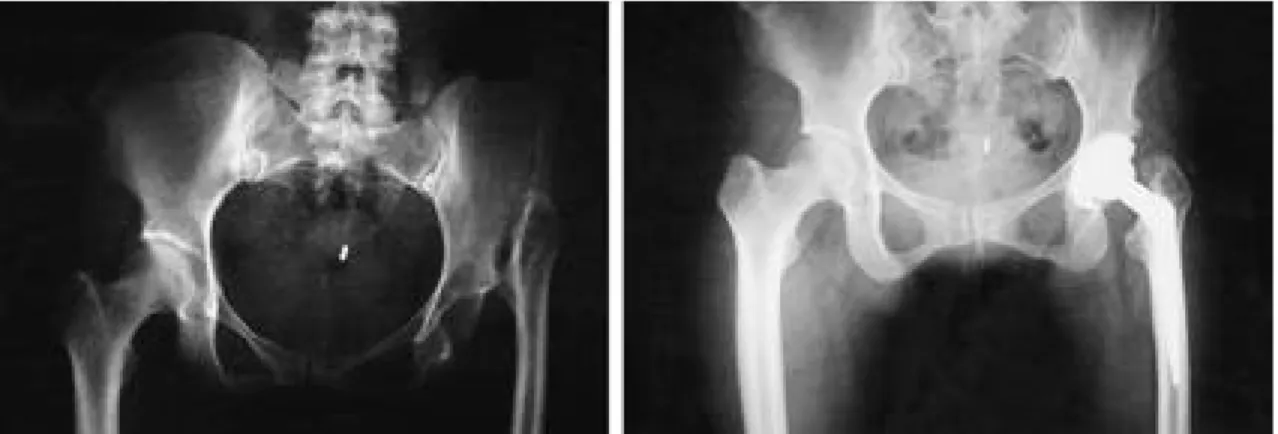 Fig. 1-A. Preoperative AP view showed severe deformed femur and marked destructive hip with proximal migration in left side as a sequale of the pyogenic arthritis.