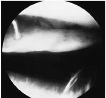 FIGURE 1. T1-weighted sagittal Magnetic Resonance Image of right knee shows the homogenous intermediate signal masses in the suprapatellar pouch(wedge) and medial head of the Gastrocnemius(arrow).
