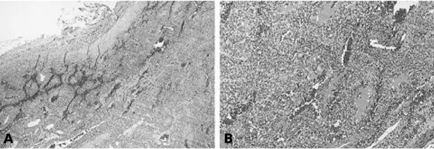 FIGURE 3. Photomicrographs of the histological sections from biopsy. A. H &amp; E stain(×40)