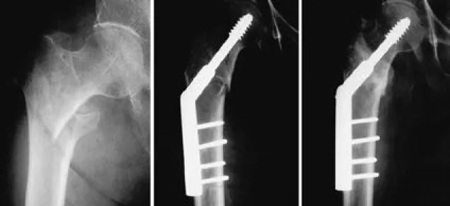 Fig. 1-B. Immediate postoperative radiograph shows fracture was reduced by Wanye-County method