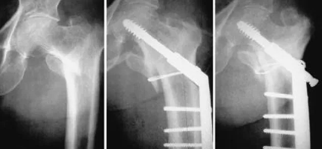 Fig. 1-B. Immediate postoperative radiograph shows fracture was reduced with medial cortical overlapping by Wayne-County reduction and lesser trochanter fixation with a wire