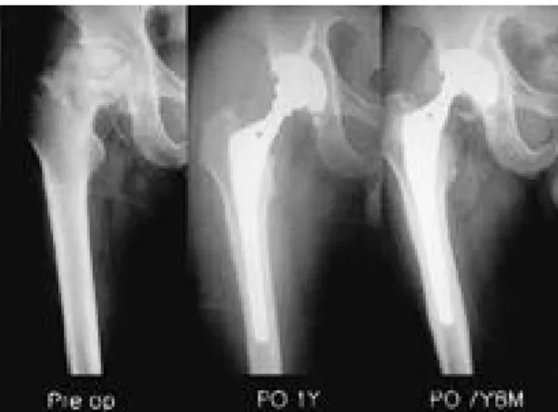 Fig. 2. Postoperative 1 year radiograph shows that cup and stem was stably fixed with tight press-fit.