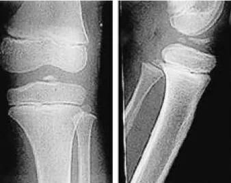 FIGURE 1. Radiographs of 7 years old girl showing type III avulsion fracture of tibial spine