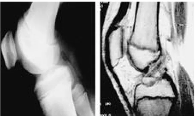 FIGURE 4. A . Radiographs showing reduction and fixation with two cannulated screws.  B 