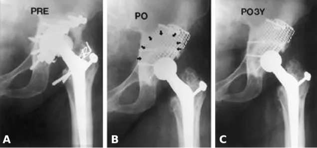 Fig. 2. A. Preoperative radiograph of 50-year old female patient showed combined cavitary/segmental deficiency of the acetabulum