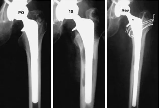 Fig. 6. A 56 years old male. Note the multifocal osteolysis along the stem. Revision was needed at postoperative 10 years.