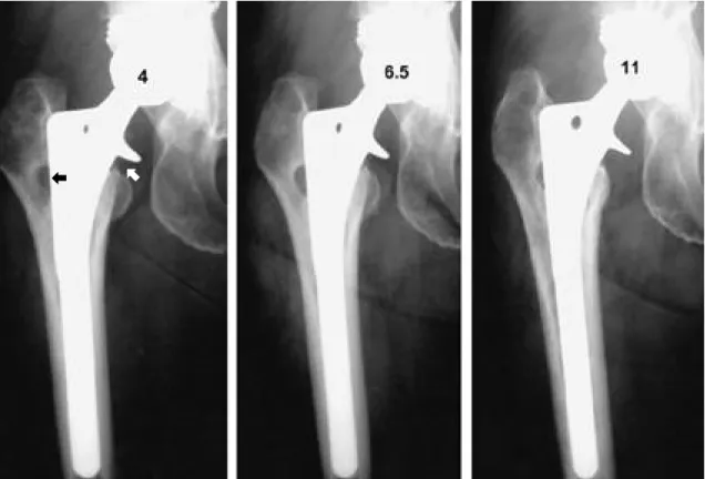 Fig. 7. A 69 years old female. Four years postoperatively, there was seen punch-out lesion in the zone I(black arrow) and subcollar resorption(white arrow)