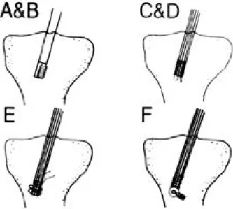 FIGURE 2. Schematic drawing shows 6 different tibial fixa- fixa-tion techniques for anterior cruciate ligament reconstruction