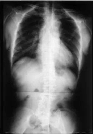 Fig. 1. B. 50 years old female who had no pseudoacetabulum on left hip showed good clinical function.