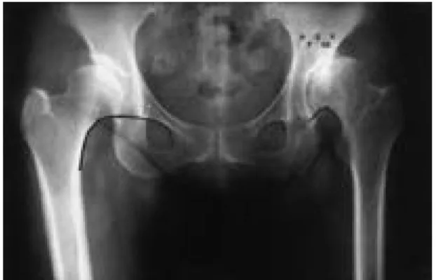 Fig. 4. Both knee AP roentgenogram of 65 years old woman has unreduced unilateral dislocation of right hip shows ipsilateral valgus deformity and contralateral varus deformity and degenerative changes in both knee.