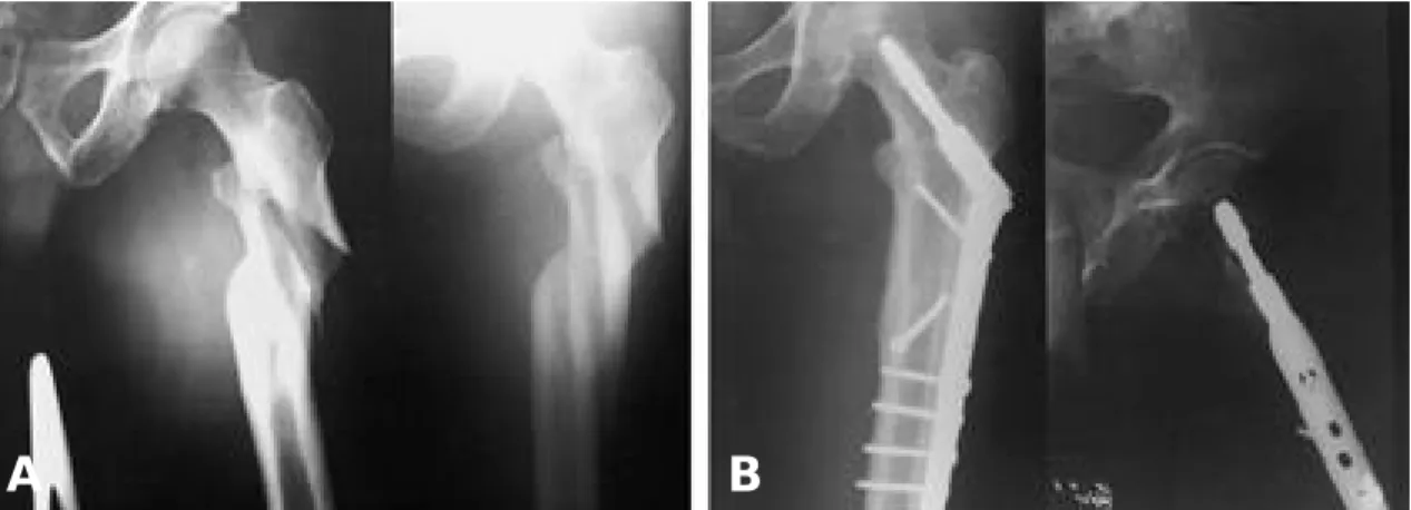Fig. 2. 60 year old man with subtrochanteric fracture of femur(Seimsheimer type Ⅲb) was treated by compressive hip screw and additional lag screw fixation