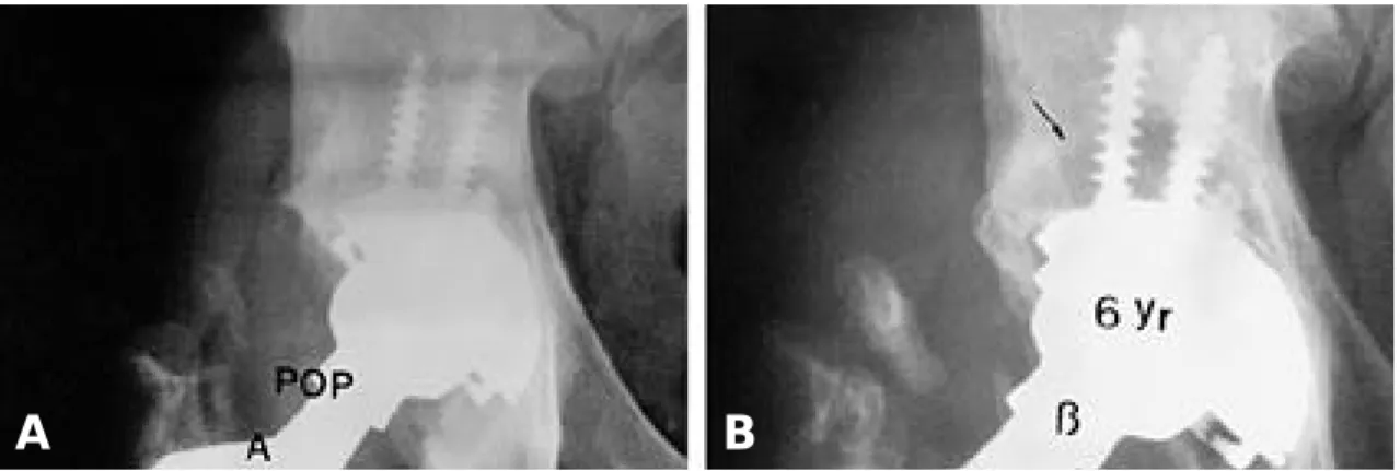 Fig. 1. A. The immediate postoperative radiograph shows a good fixation of cup. B. Six years follow-up radiograph shows osteolysis around Zone I and II and there is upward displacement of femoral head suggesting excessive wear of the polyethylene liner