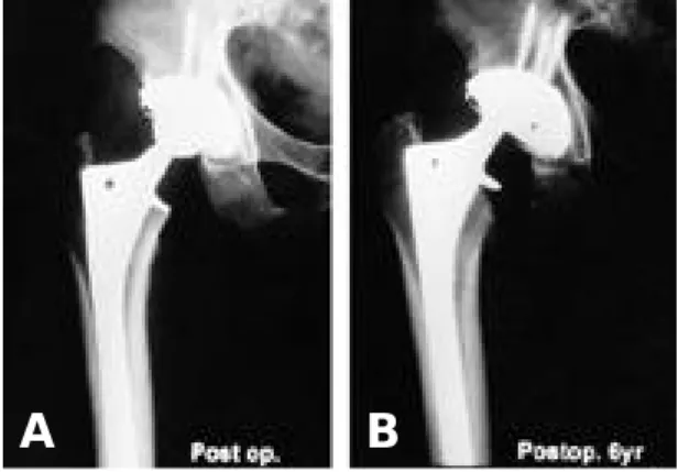 Fig. 2. A . Immediate postoperative radiograph of non- non-cemented HGP 2 acetabular component and Multilock femoral stem