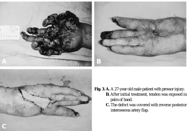 Fig. 3. B. After initial treatment, tendon was exposed in palm of hand.