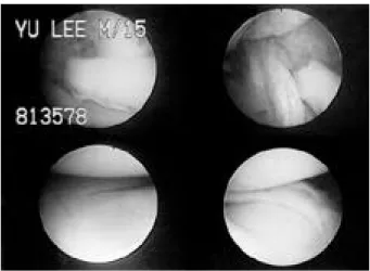 FIGURE 1. Arthroscopic photograph of a 15 year-old male student with a displaced bucket handle tear of the medial meniscus(right and left upper), which was repaired  by  inside-out  technique  after reduction(left lower) and showed an excellent clinical re