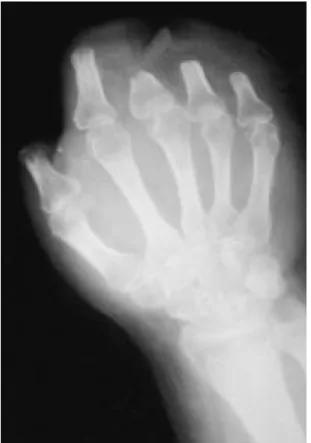 Fig. 3. The wrap around flap was isolated from the great toe.