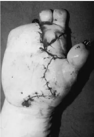 Fig. 6. The thumb, second and third finger were recon- recon-structed by microsurgical technique.