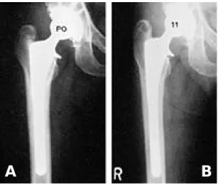 Fig. 3. The immediate postoperative radiograph of 72 years old male shows the excellent bone  in-growth fixation around the stem(A), and the stem fixation is perfect in postoperative 11 year  radi-ograph(B).