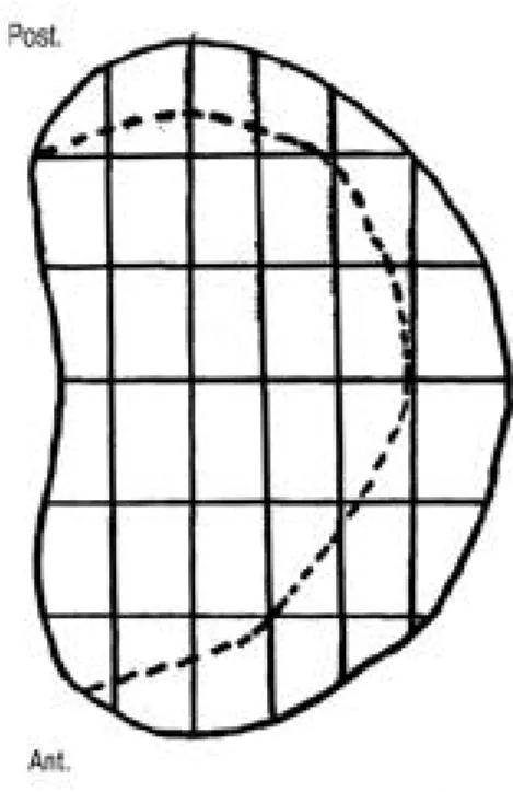 FIGURE 2. The Schematic diagrams of discoid meniscus which is drawn by orthopedic surgeon , it  illus-trate the margin of remaining meniscus .