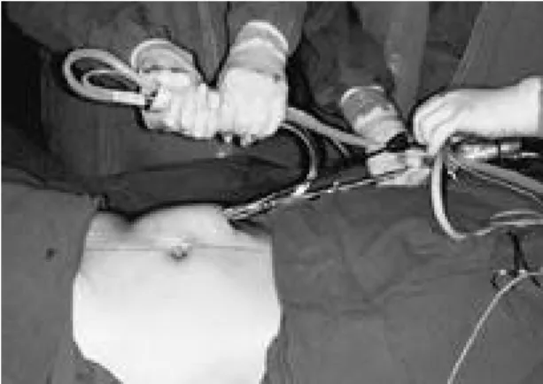 Fig. 2. Rectus abdominis muscle is harvested with endo- endo-scopic assistance. Muscle is separated from the fascia with endoscopic cautery and scissors.