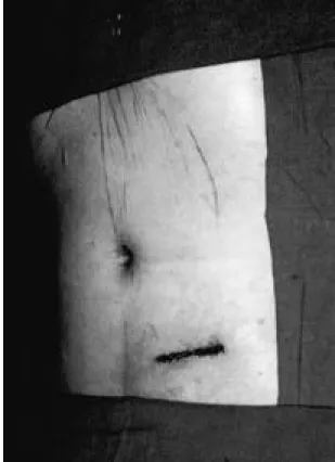 Fig. 5. 5 cm long incision is located on the lower abdo- abdo-men. It is placed transversely under the  umbili-cus so that it can be concealed with swimming pants.