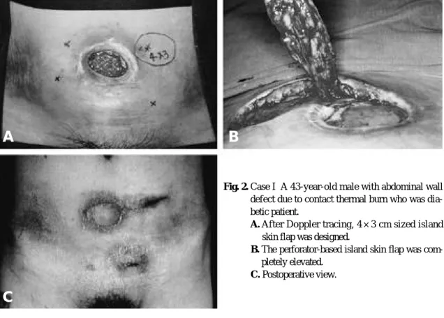 Fig. 2. Case I  A 43-year-old male with abdominal wall defect due to contact thermal burn who was  dia-betic patient.