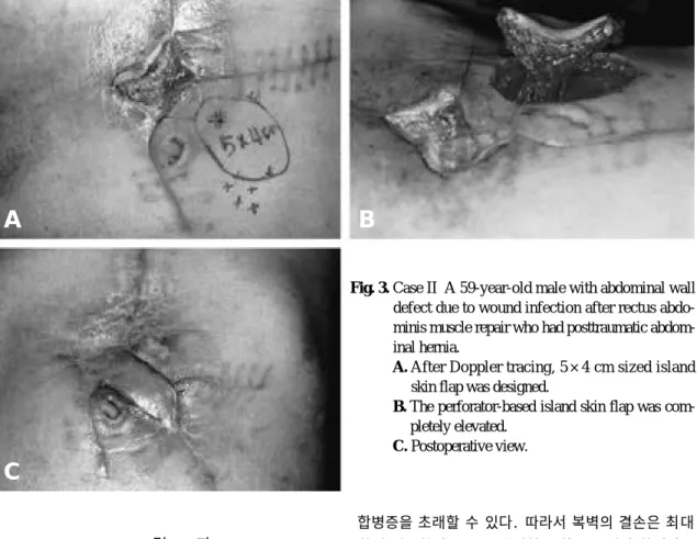 Fig. 3. Case II  A 59-year-old male with abdominal wall defect due to wound infection after rectus  abdo-minis muscle repair who had posttraumatic  abdom-inal hernia