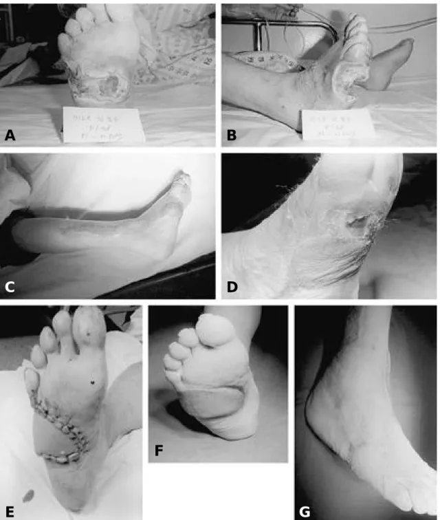 Fig. 3. A, B. A 48-year-old female patient(case 4) with infected foot ulcer on the plantar surface of the right foot