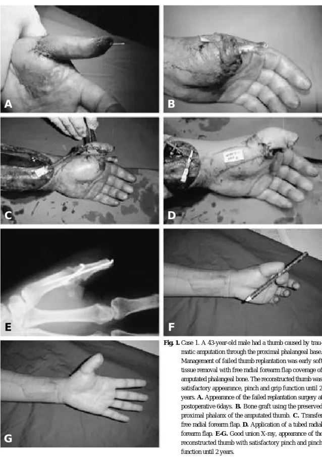 Fig. 1. Case 1. A 43-year-old male had a thumb caused by trau- trau-matic amputation through the proximal phalangeal base.