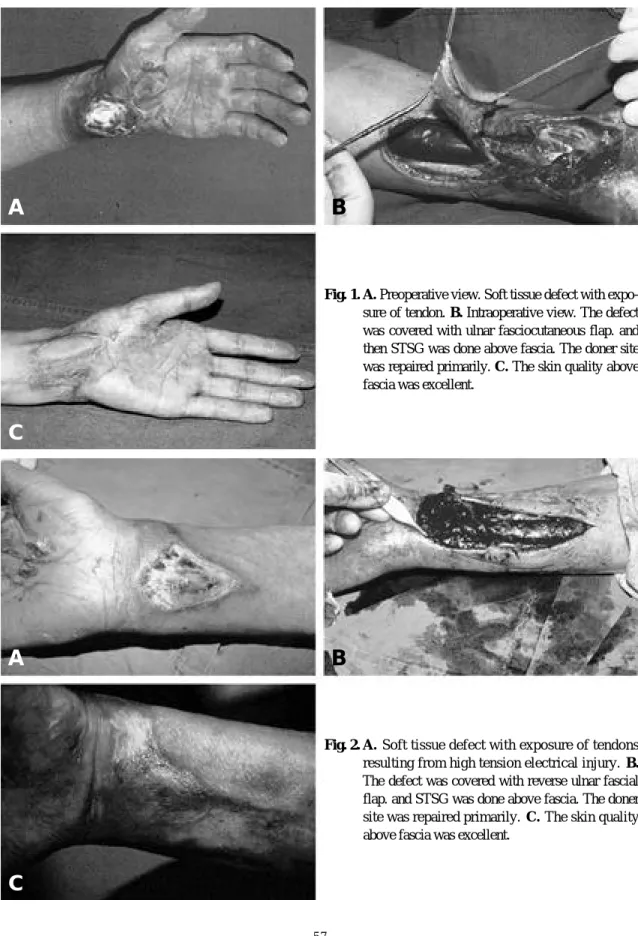 Fig. 1. A. Preoperative view. Soft tissue defect with expo- expo-sure of tendon. B. Intraoperative view