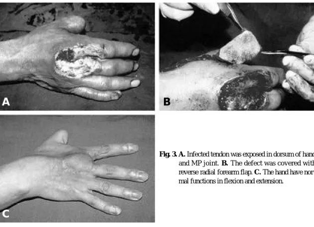 Fig. 3. A. Infected tendon was exposed in dorsum of hand and MP joint. B . The defect was covered with reverse radial forearm flap