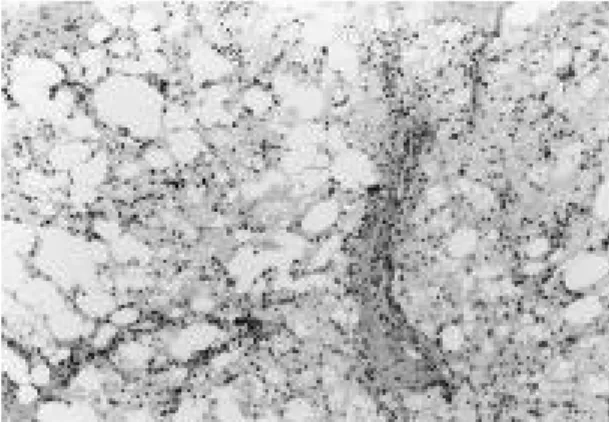 Fig. 3. Microscopic finding shows aggregates of foamy histiocytes surrounding fat vacuoles with extensive fat necrosis(HE stain, ×200).