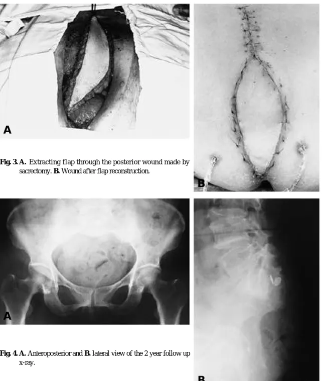 Fig. 3. A . Extracting flap through the posterior wound made by sacrectomy. B. Wound after flap reconstruction.