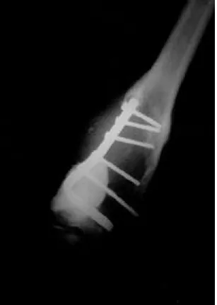 Fig. 3. Extensive curettage and fillings with methyl- methyl-methacrylate were done, and then condylar blade plate was applied.