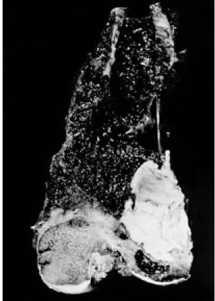 Fig. 7. Gross finding shows recurrent lesions above and below cement fillings.