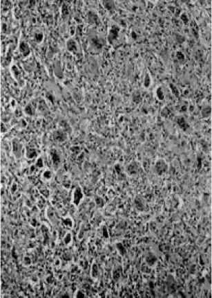Fig. 9. Microscopic finding of metastatic lung lesion shows diffuse distribution many giant cells in the background of mononuclear cell(×200,  Hema-toxylin-Eosin stain).