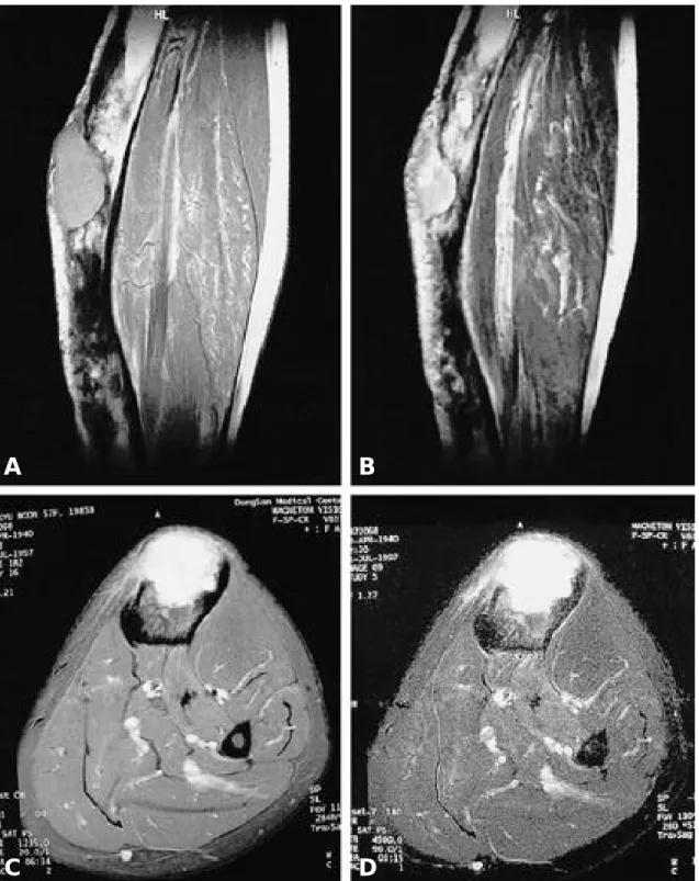 Fig. 2. The preoperative MRI reveals well defined solid mass in anterior bony cortex at diaphysis of tibia with exo and endosteal growing pattern