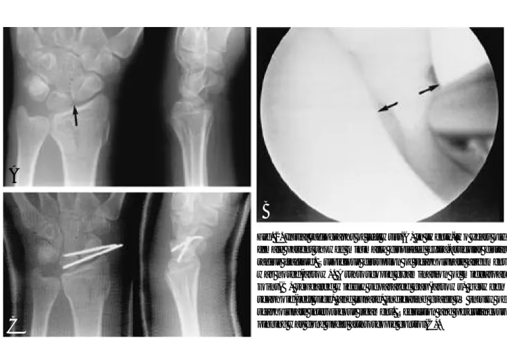 Fig. 2. Initial radiographs of left wrist(A) in twenty-two years old female patient showed minimally displaced extra-articular distal radius fracture
