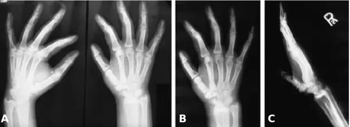 Fig. 2. Roentgenographically proximal and distal phalanx of the Rt. thumb. middle phalanx of the Rt
